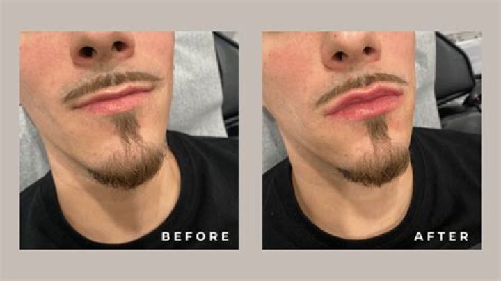Lip Filler for Men